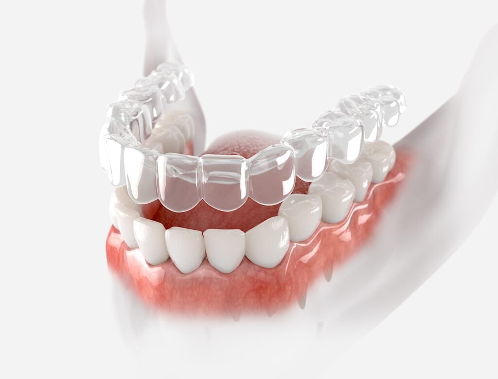 Invisalign in Shoreline