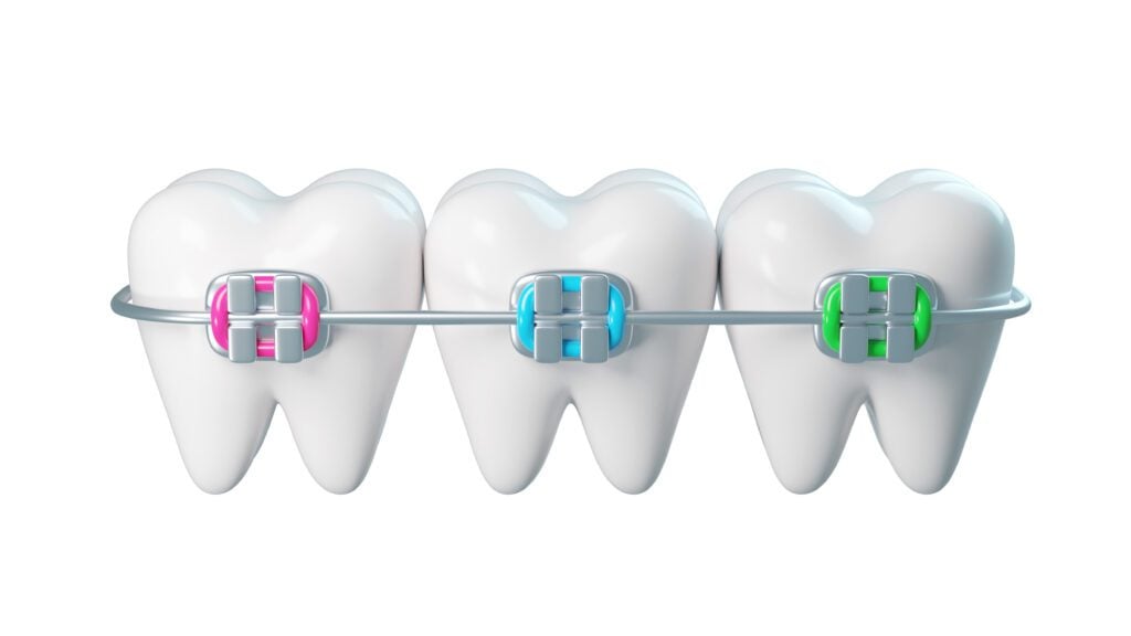 orthodontist in Shoreline