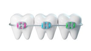 orthodontist in Shoreline
